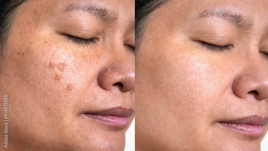 Pigmentation Permanent treatment