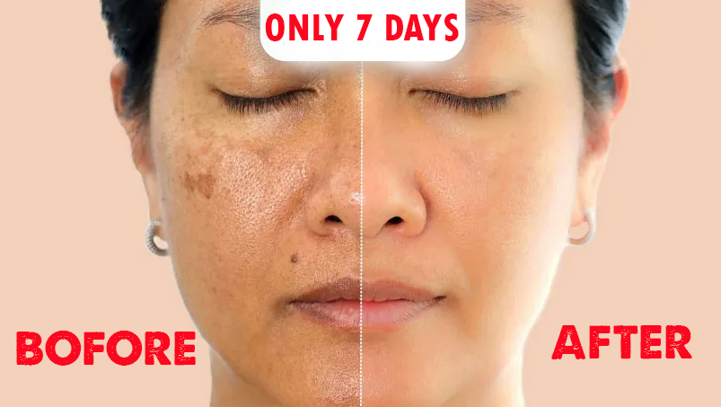 Pigmentation Permanent treatment